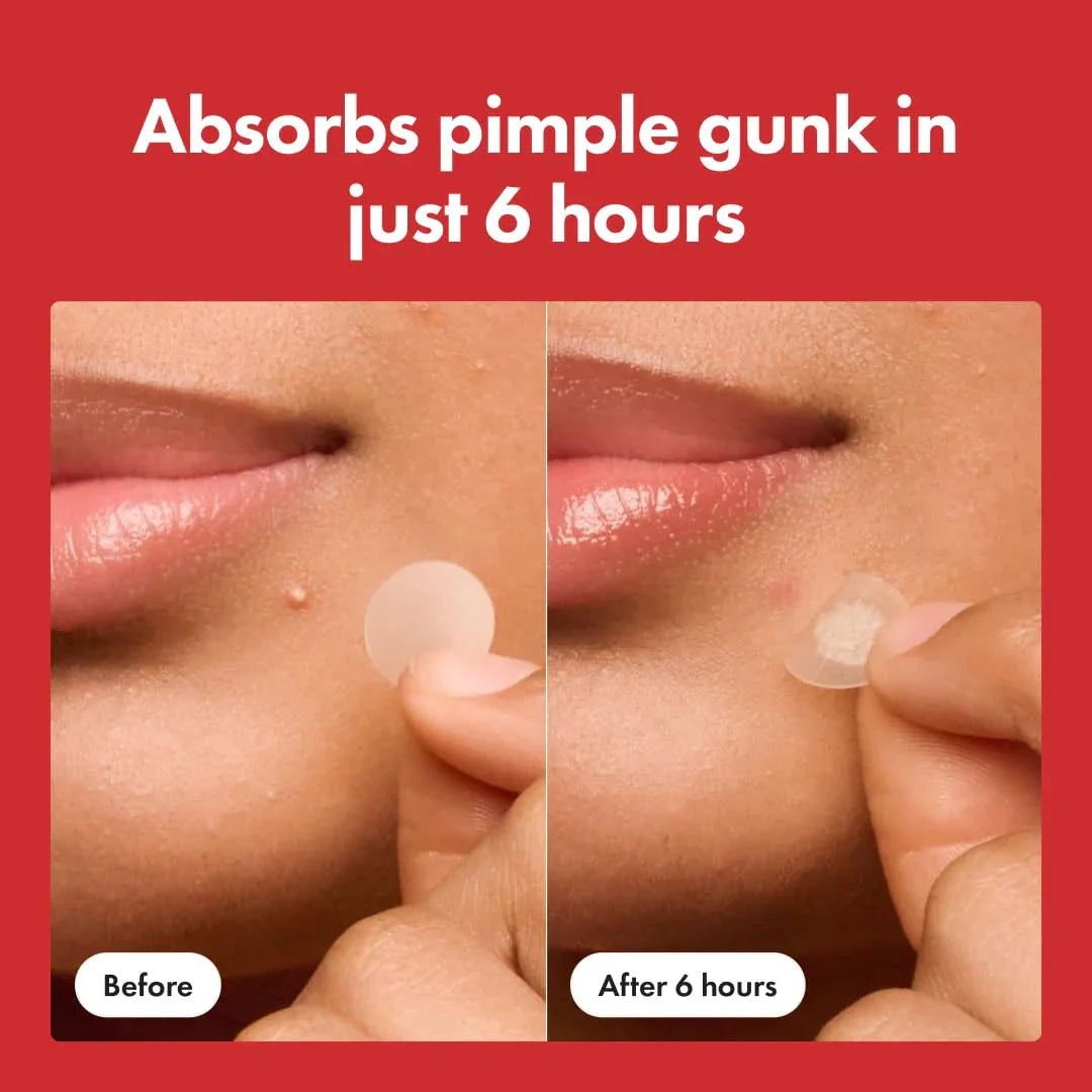Mighty Patch | Pimple Patches | Hydrocolloid Acne Patches: The #1 Overnight Solution - Strike Algo